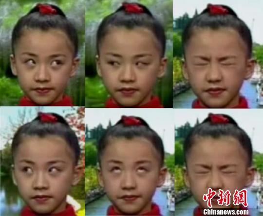 网友吐糟新版眼保健操“做操防近视”再引争议